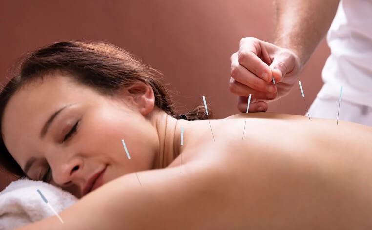 Acupuncture demonstrated on the back of a lady. This is alternative medicine.