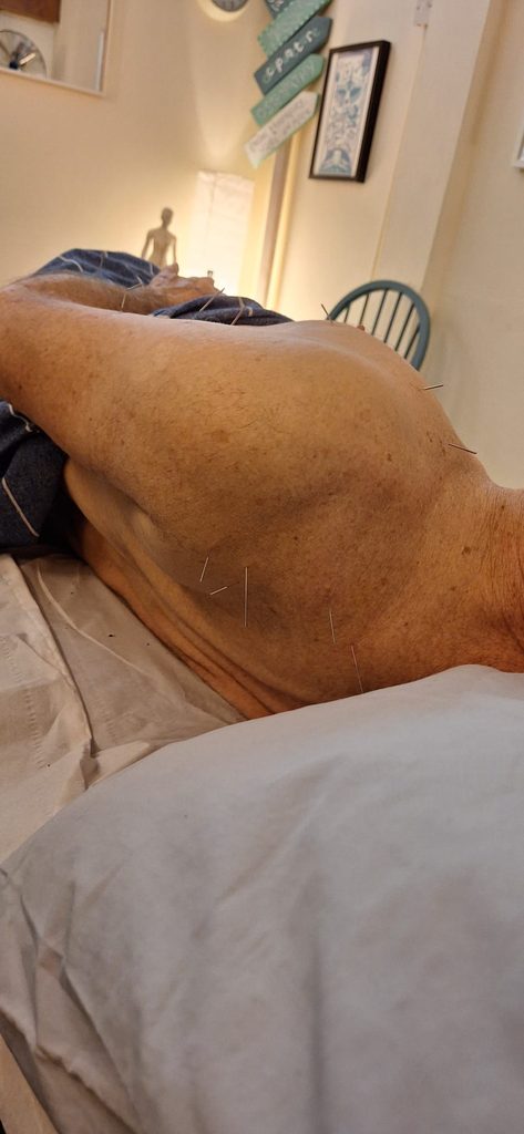 depiction of a real client being treated by acupuncture for frozen shoulder. they are lying on a treatment table, on their side. acupunctures are visible around their left shoulder all around