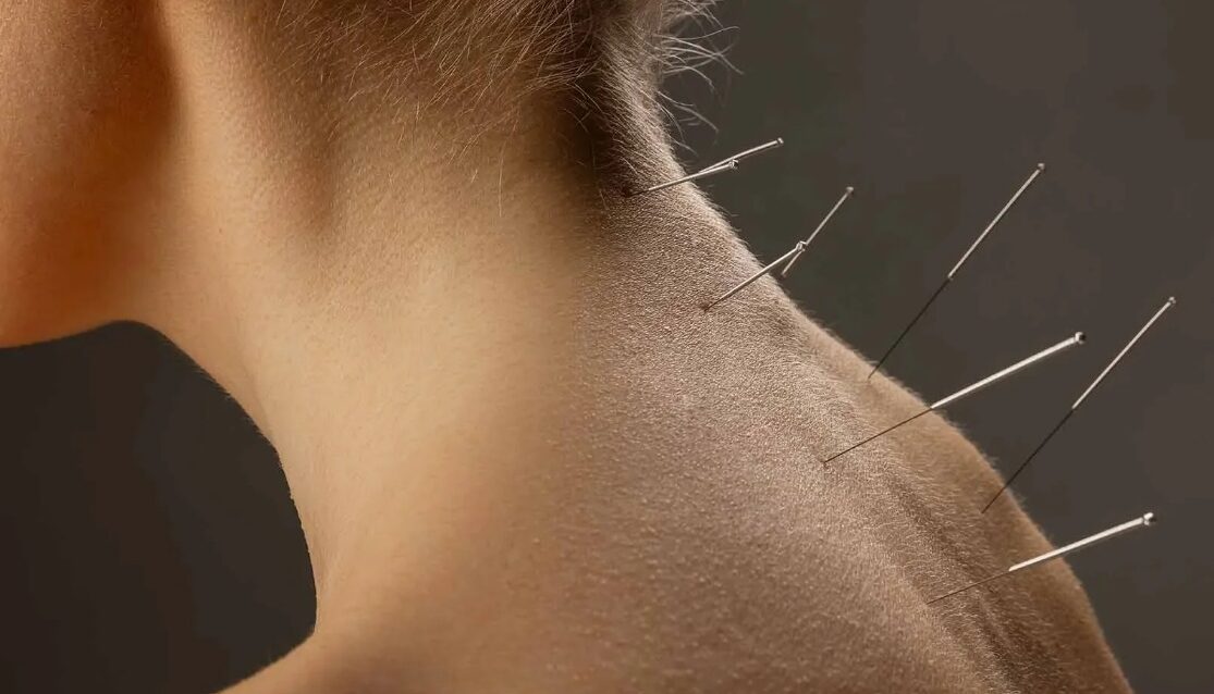 depiction of a lady receiving acupuncture on the back of their neck in crystal palace, london